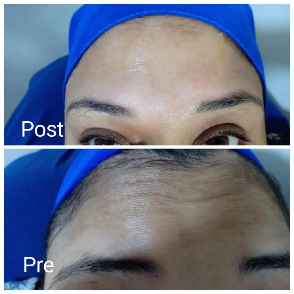 Botox injection results before and after