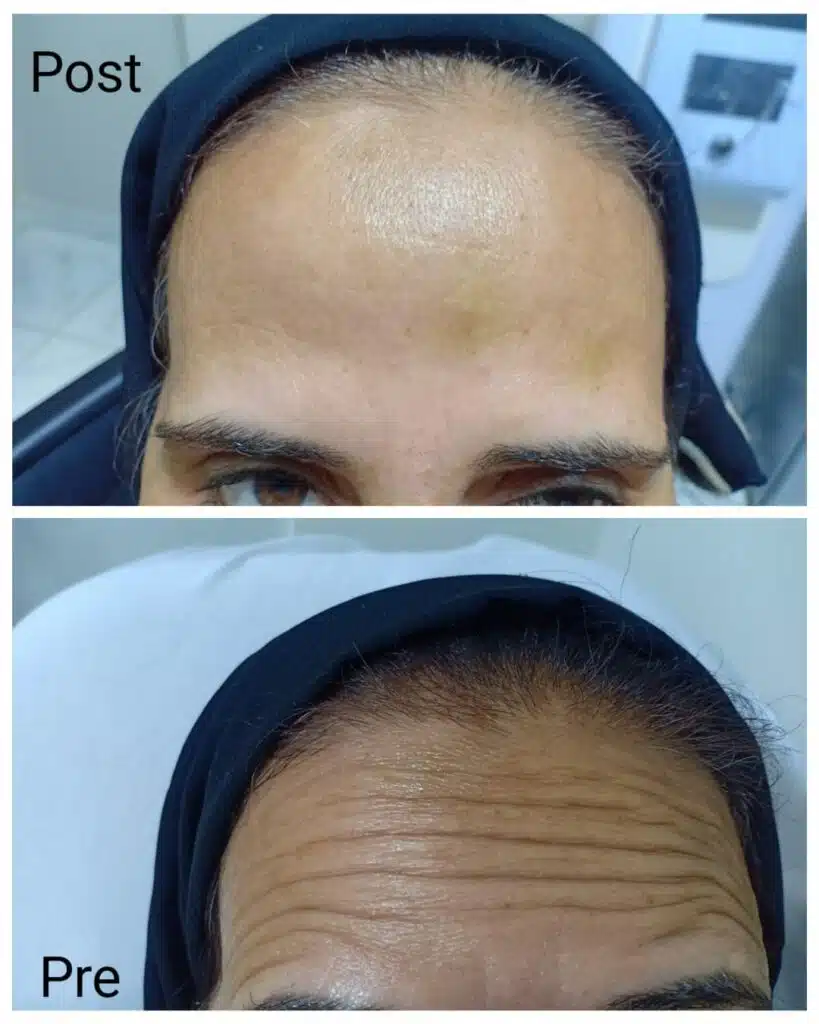 Botox injections in Hurghada to get rid of forehead lines