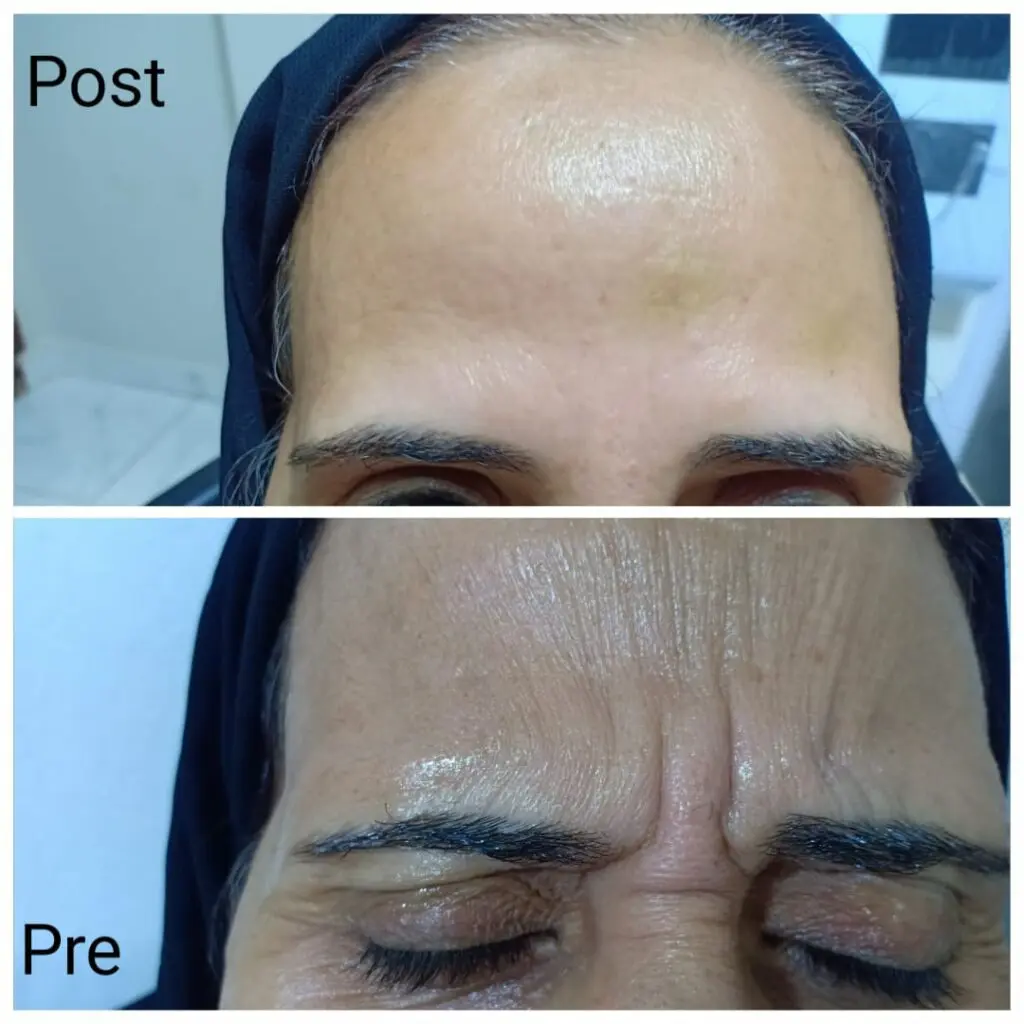 Removing wrinkles between the eyebrows 111 by injecting Botox in Hurghada