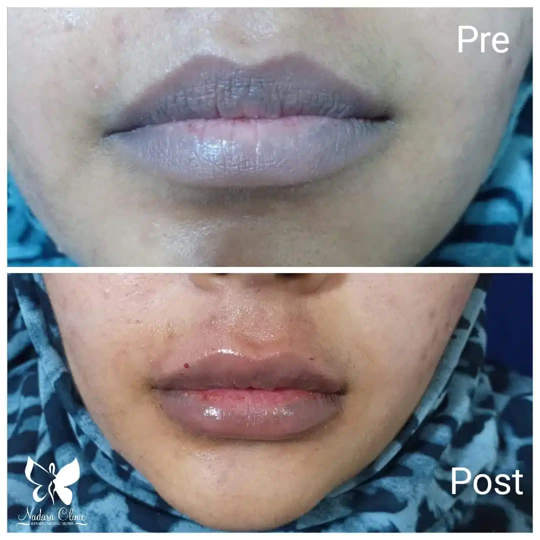 Lip Augmentation Filler in Hurghada