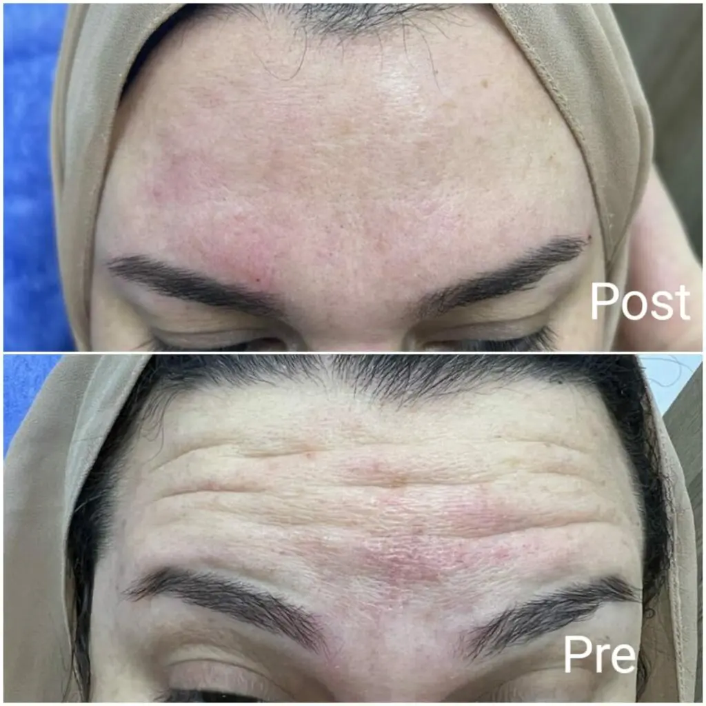 Results of Botox injections in Hurghada before and after