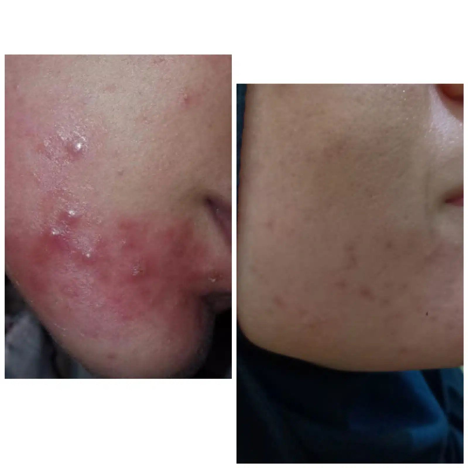 Photo before and after treatment of facial pills