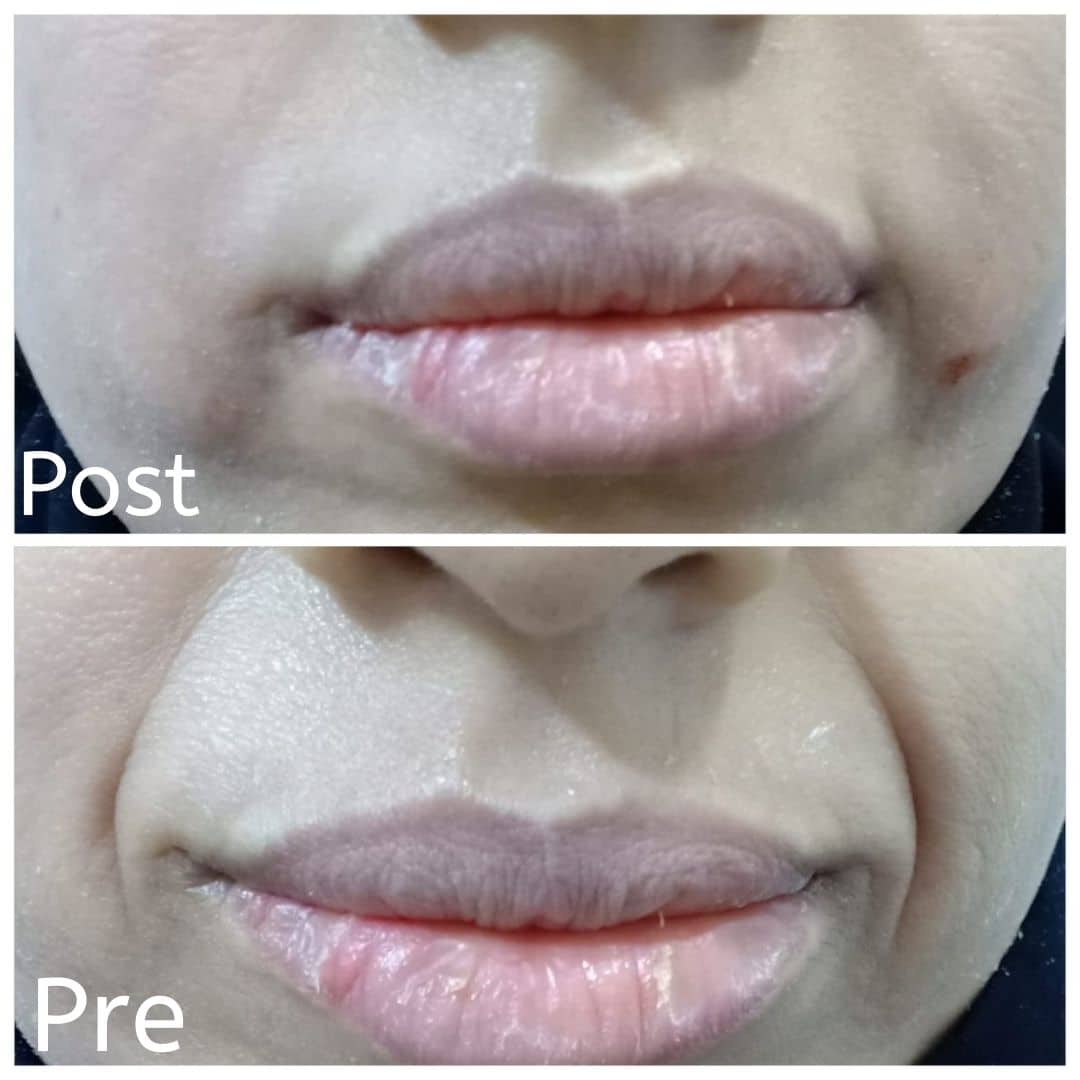 Removing lines around the mouth with filler injections