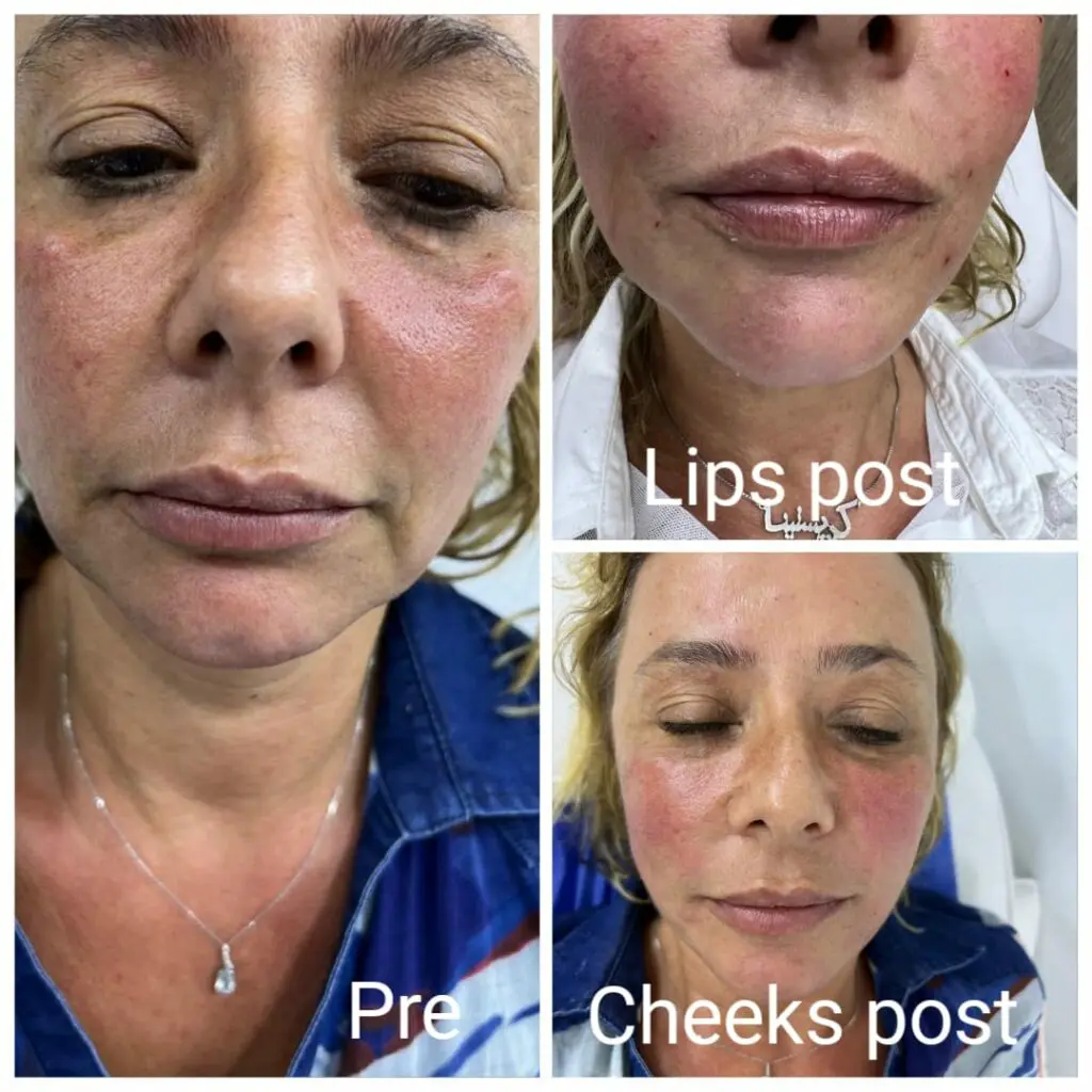 Cheeks and lips injections with fillers in Hurghada