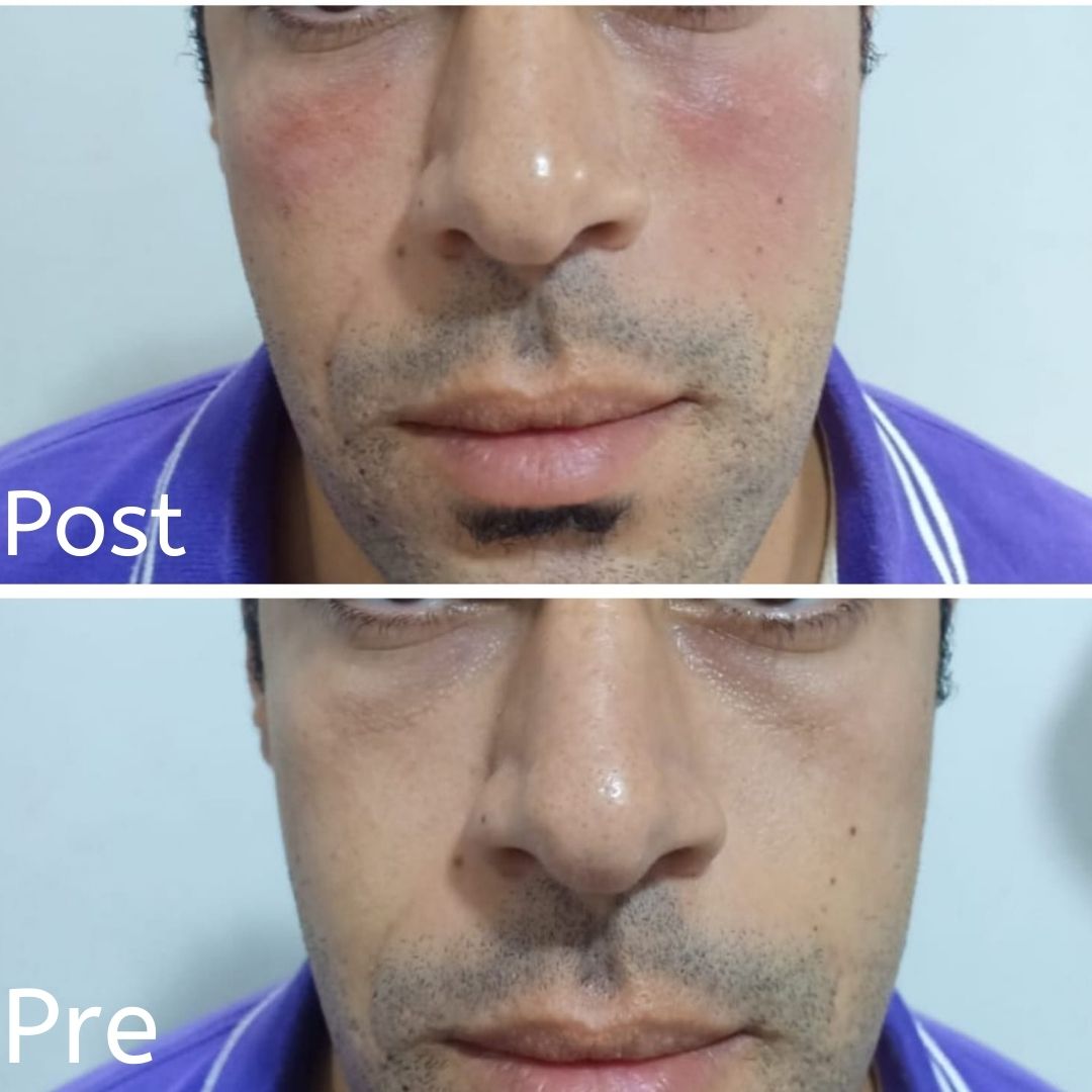 Filler injections in Hurghada to improve the appearance of dark circles in men