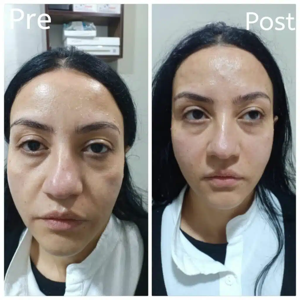 Filler injections in Hurghada for the cheeks and for the treatment of marionette lines
