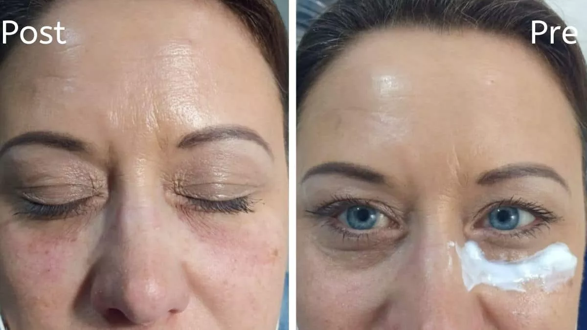 Filler injections in Hurghada with the best dermatologist to treat dark circles under the eyes and with the best dermatologists