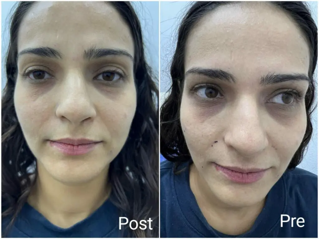 Hyaluronic injections for the face and cheeks