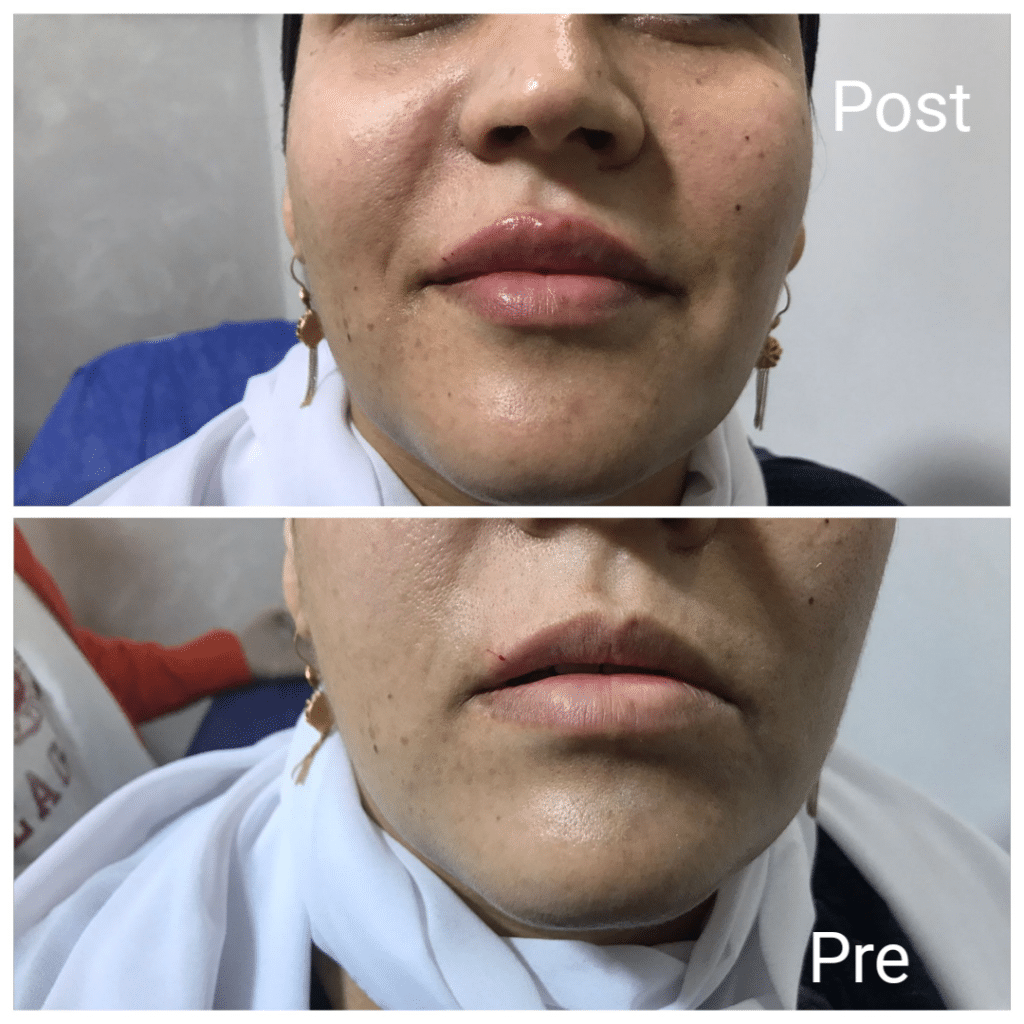 Filler injections to improve the appearance of the lips