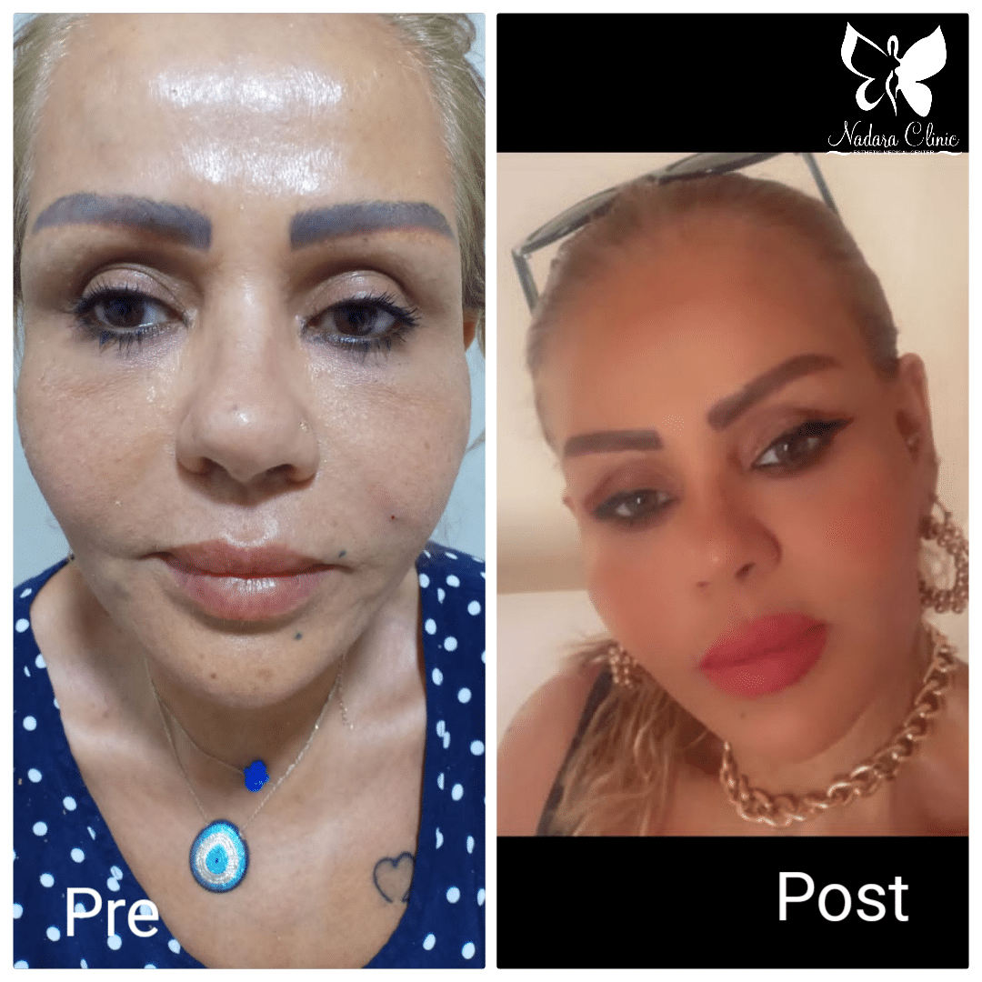 Face-lift-with-threads-after-two-weeks-Hurghada