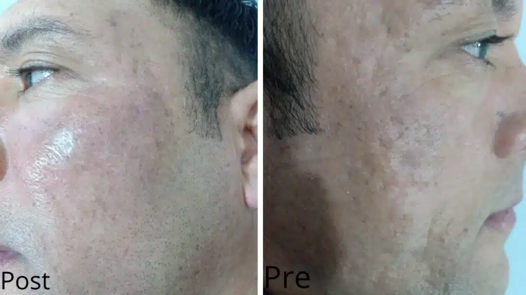 Acne scars treatment in the form of pits after only 3 sessions