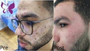 Treating acne scars in Hurghada with the best dermatologist in Hurghada