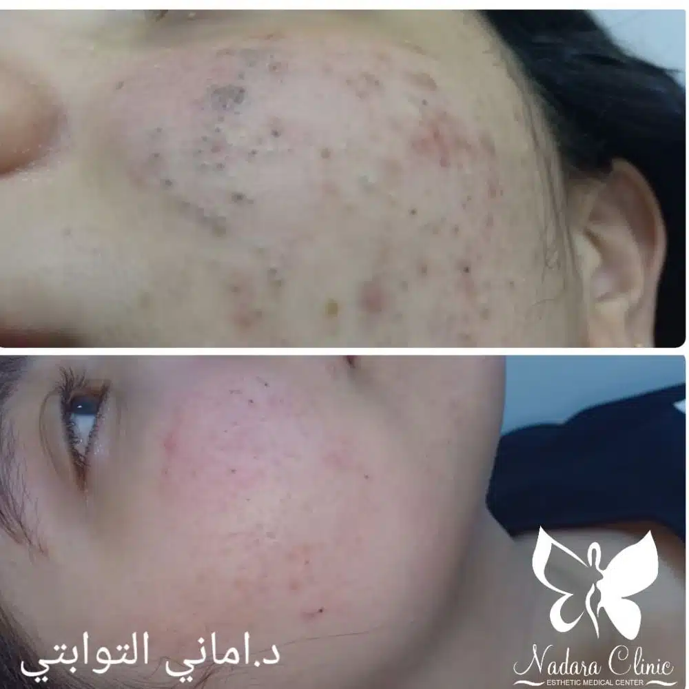 Treatment of acne scars at the Freshness Center in Hurghada