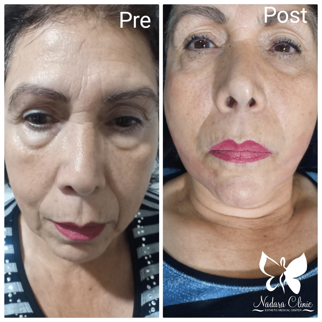 Before-and-after-face-lifting with threads in Hurghada