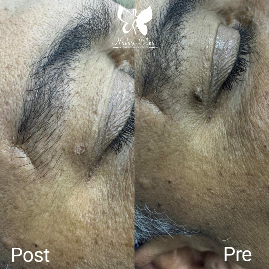 Laser skin tag removal before and after