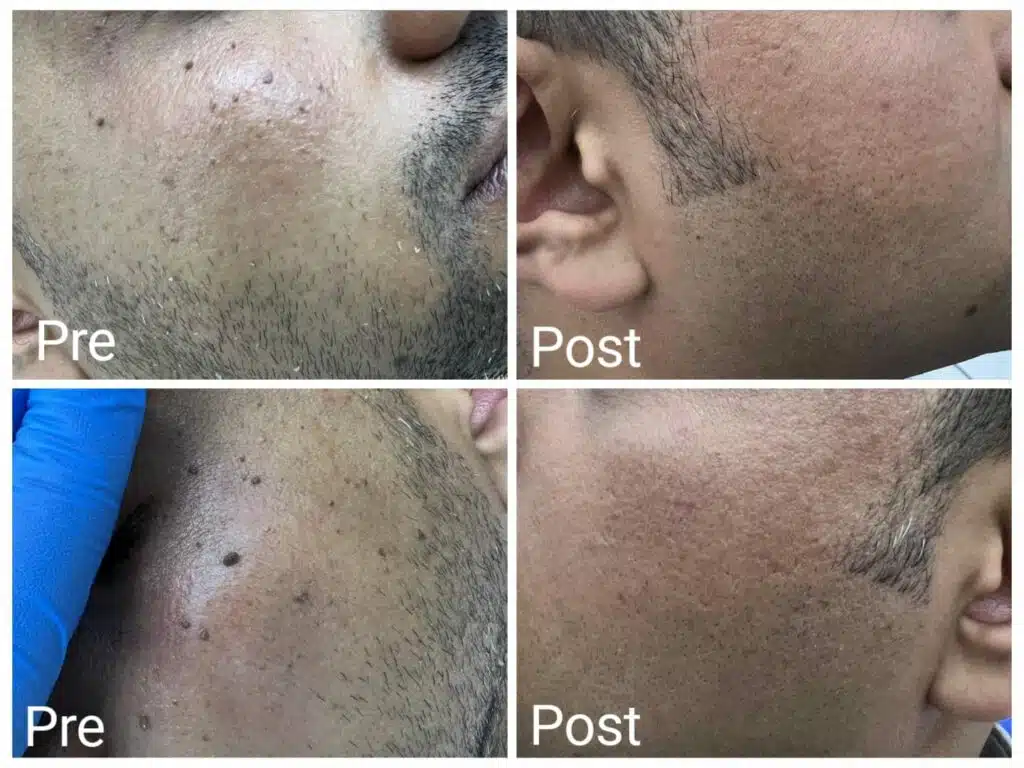 Removal of skin tags from the face in Hurghada