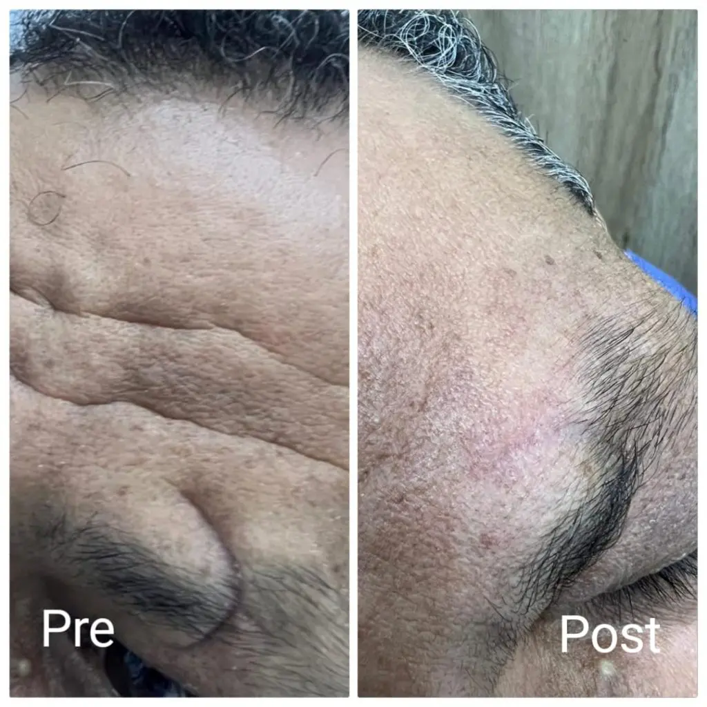 Deep skin scar removal