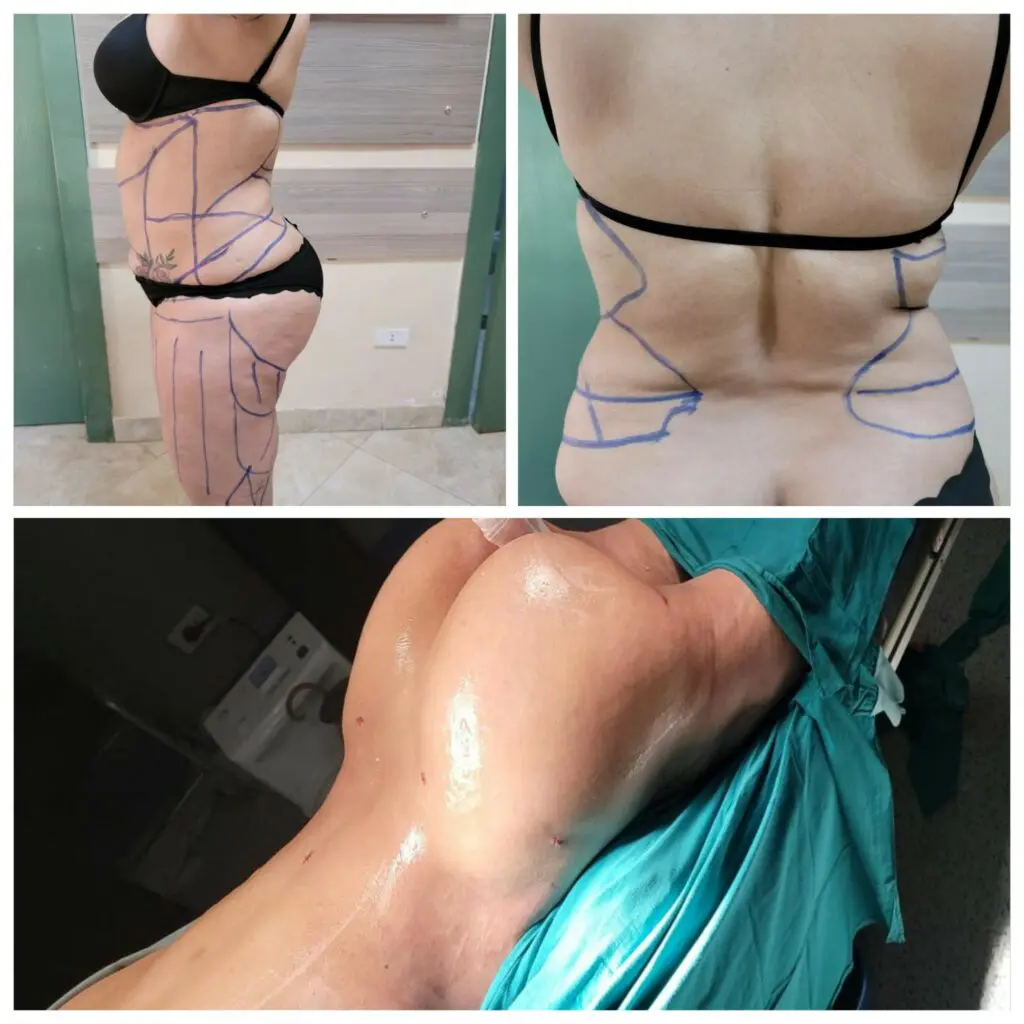 Liposuction of the sides and back with G-plasma liposuction with an improvement in the size of the buttocks
