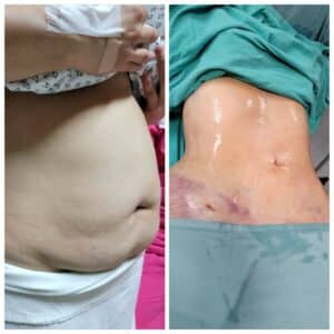 Vaser liposuction with the best dermatologists