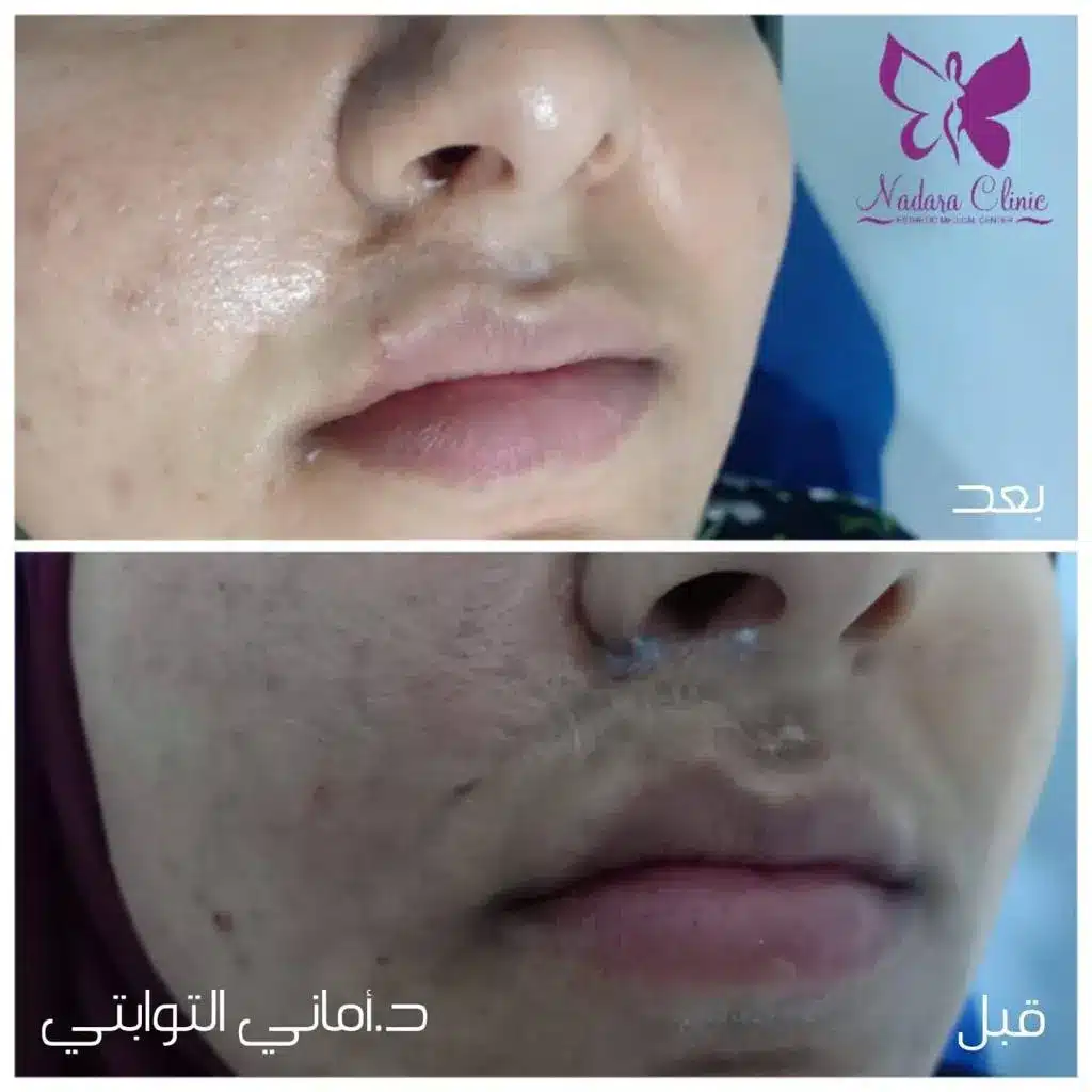 Removing the traces of accidents and scars with a laser in Hurghada