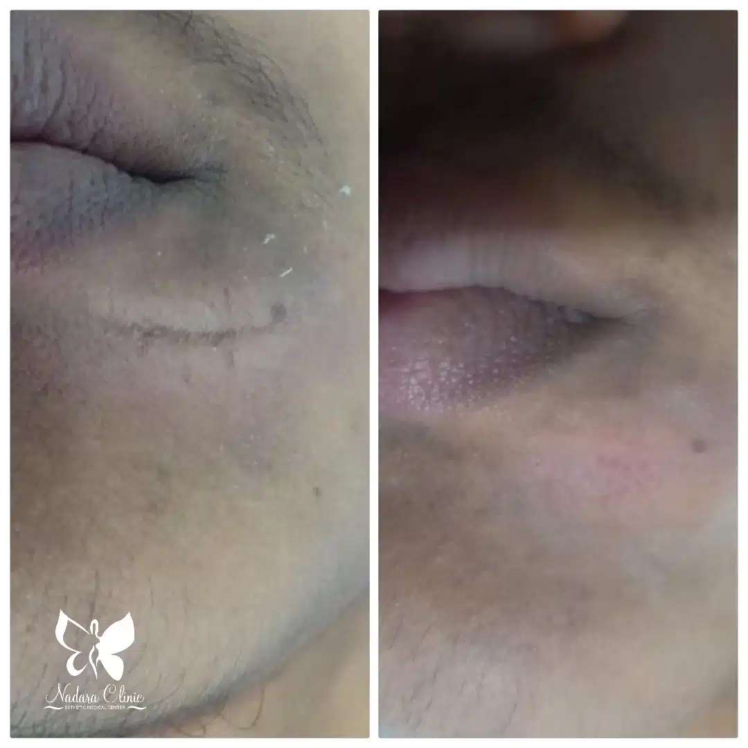 Laser stitching removal in Hurghada