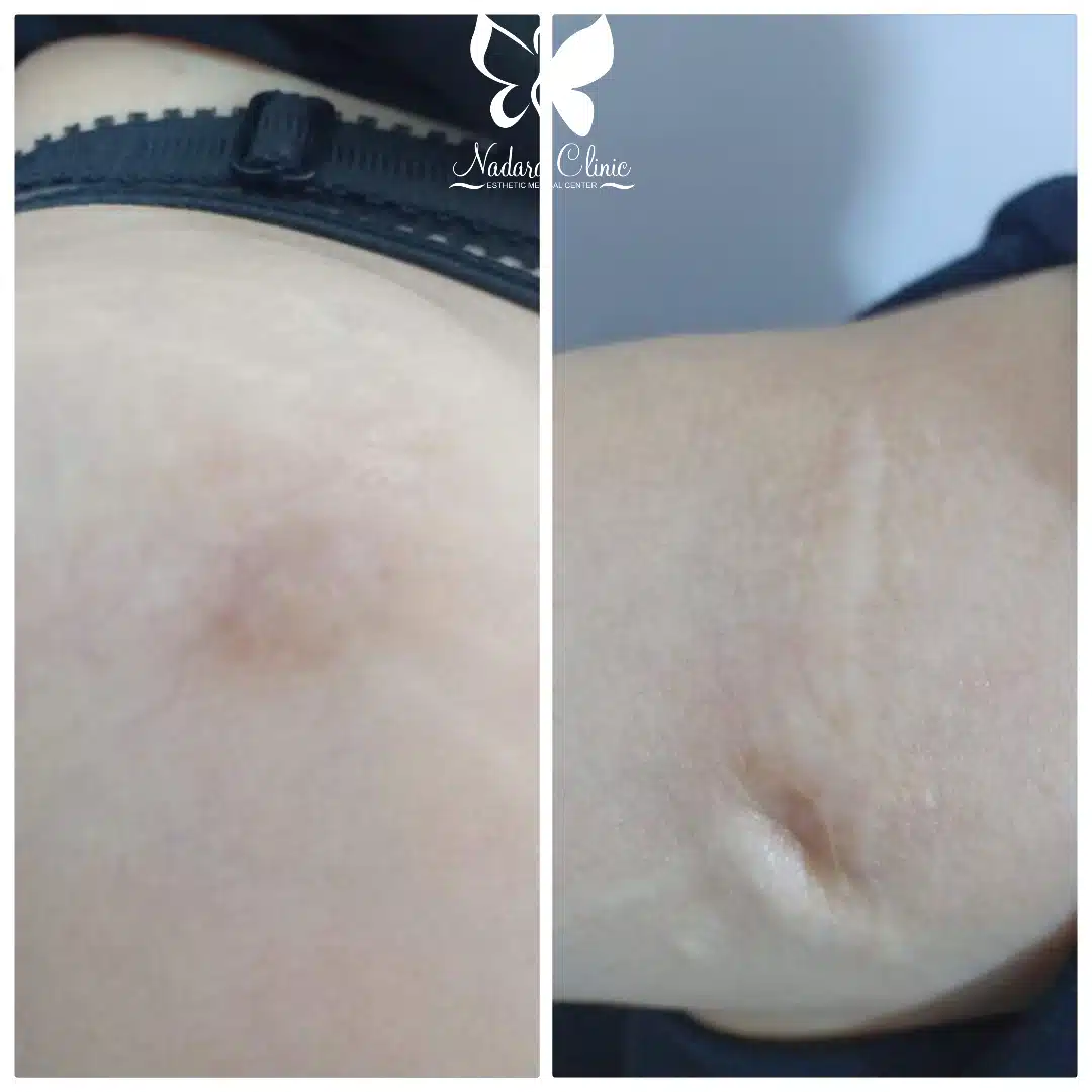 Laser scar removal of hand in Hurghada
