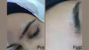 Laser scars removal in Hurghada