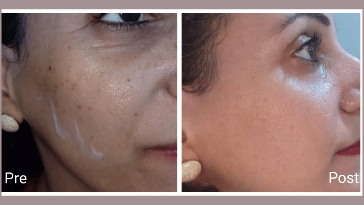 Laser freckle removal in Hurghada