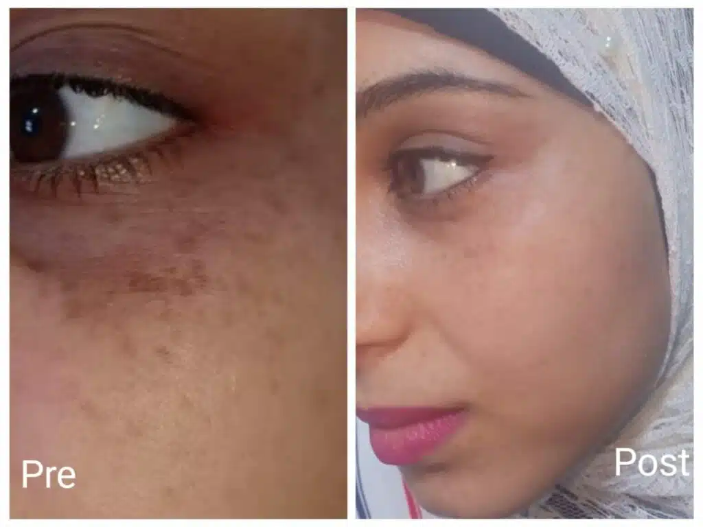 Laser freckle treatment Result after the second session