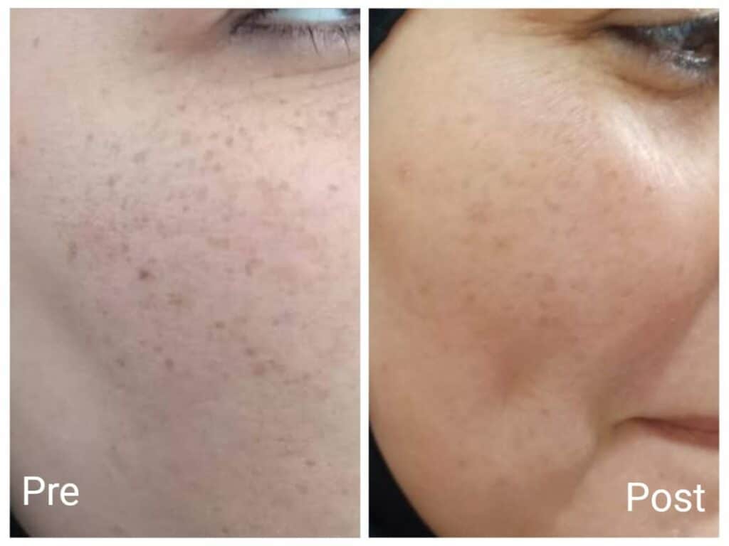 Laser freckle removal, results after two sessions