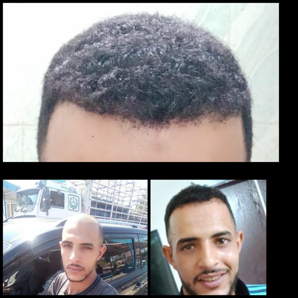 The final result of hair transplantation in Hurghada