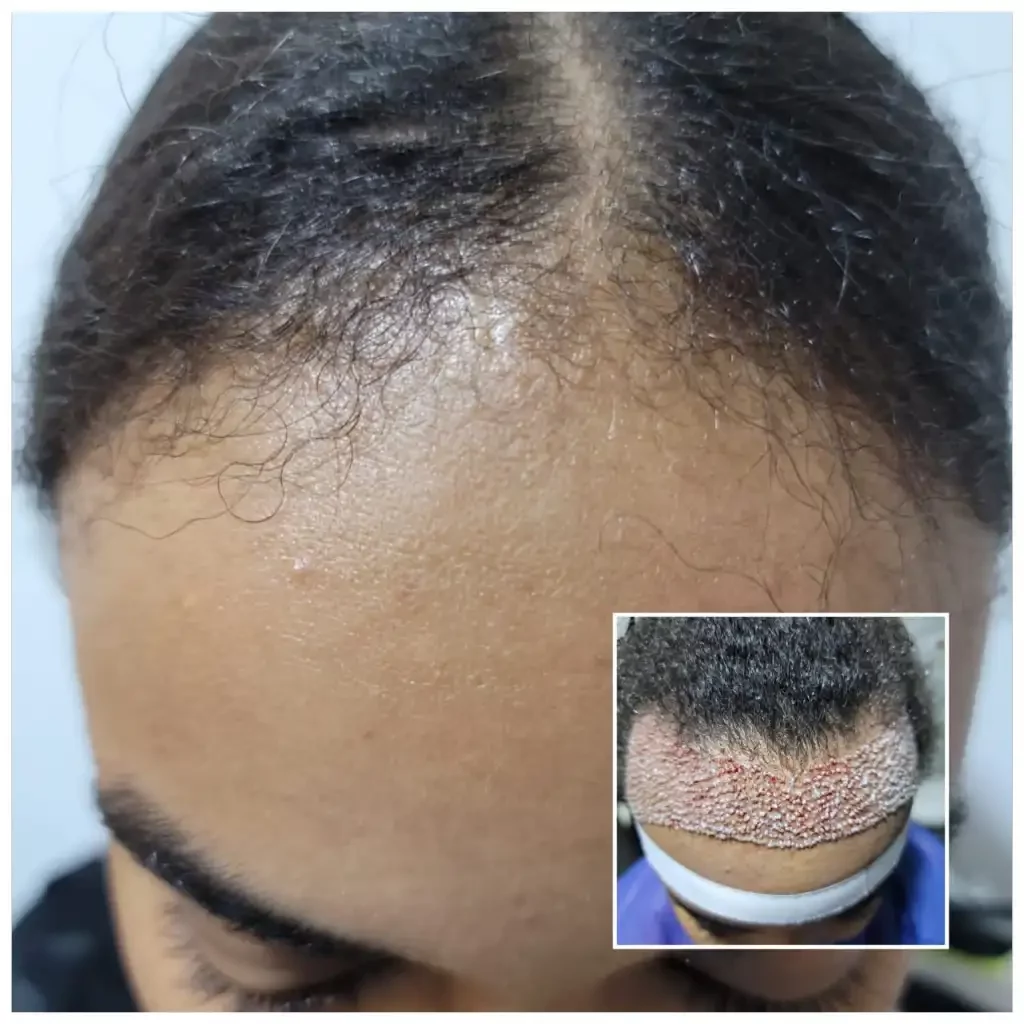 Reducing the forehead by transplanting hair to the front of the head