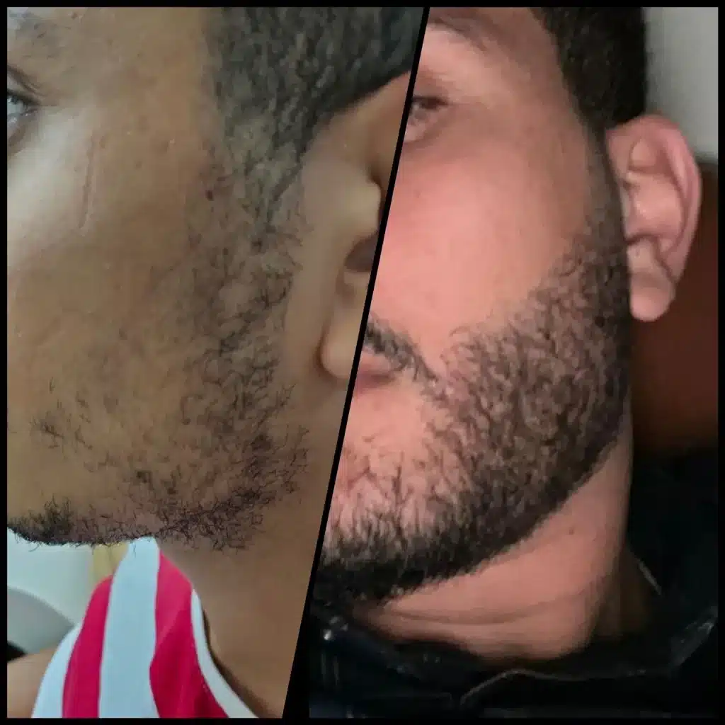 Beard hair transplant before and after