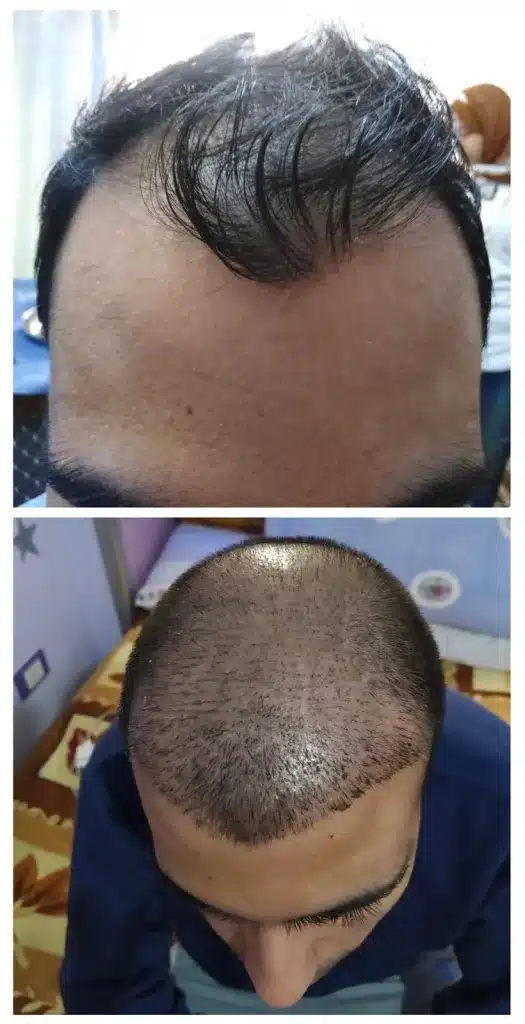 عملية زراعة الشعر في الغردقة