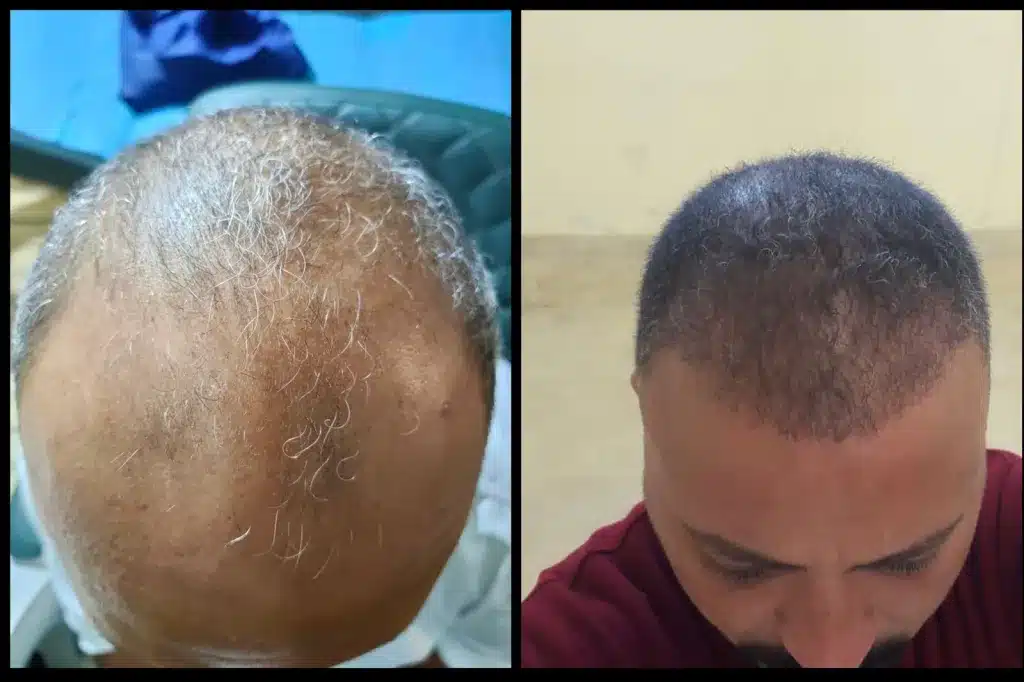 عملية زرع الشعر قبل وبعد