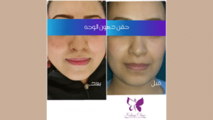 Autologous facial fat injection in Hurghada