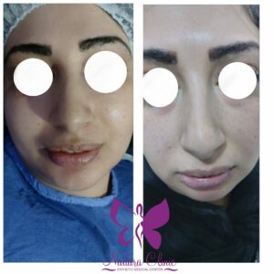 Cheek fat injection with the best dermatologists in Hurghada