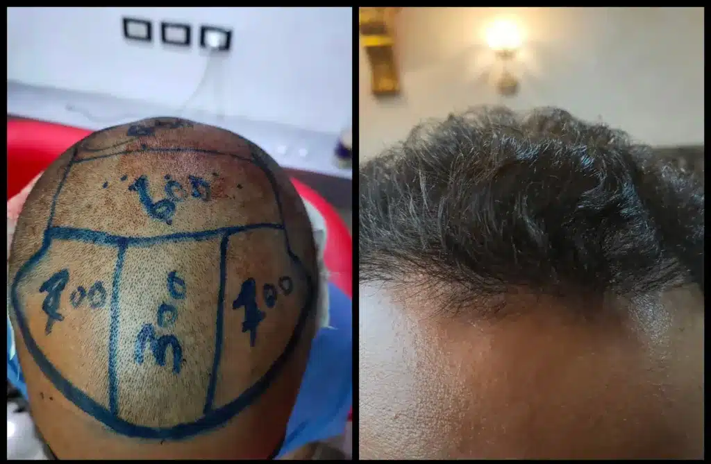 تخطيط منطقة زرع الشعر بالاقتطاف