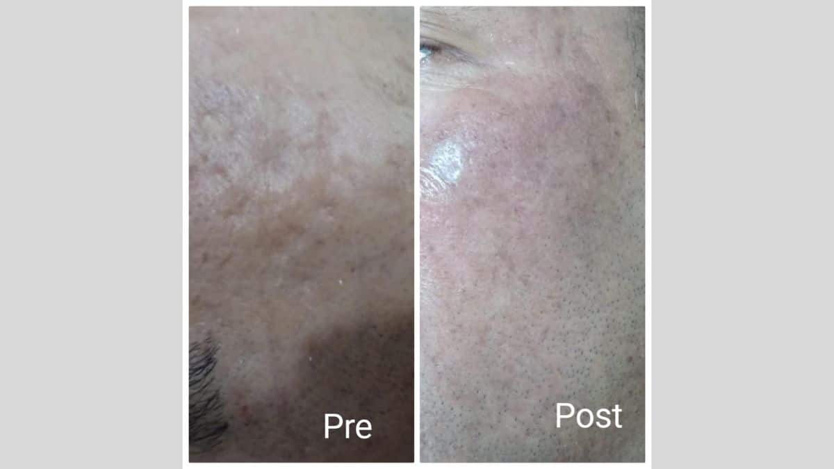 Getting rid of large pores in Hurghada