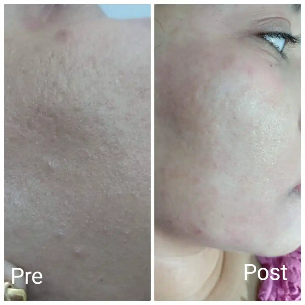 Treating large pores in Hurghada