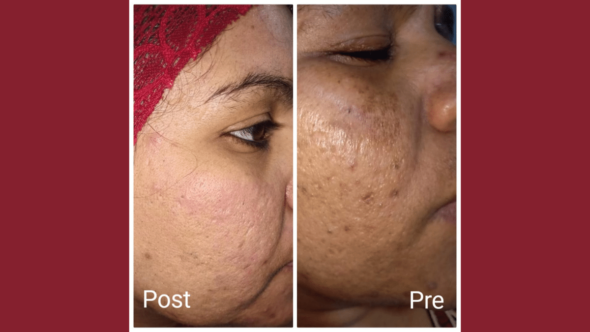 Unifying skin color and get rid of the traces of acne in Hurghada