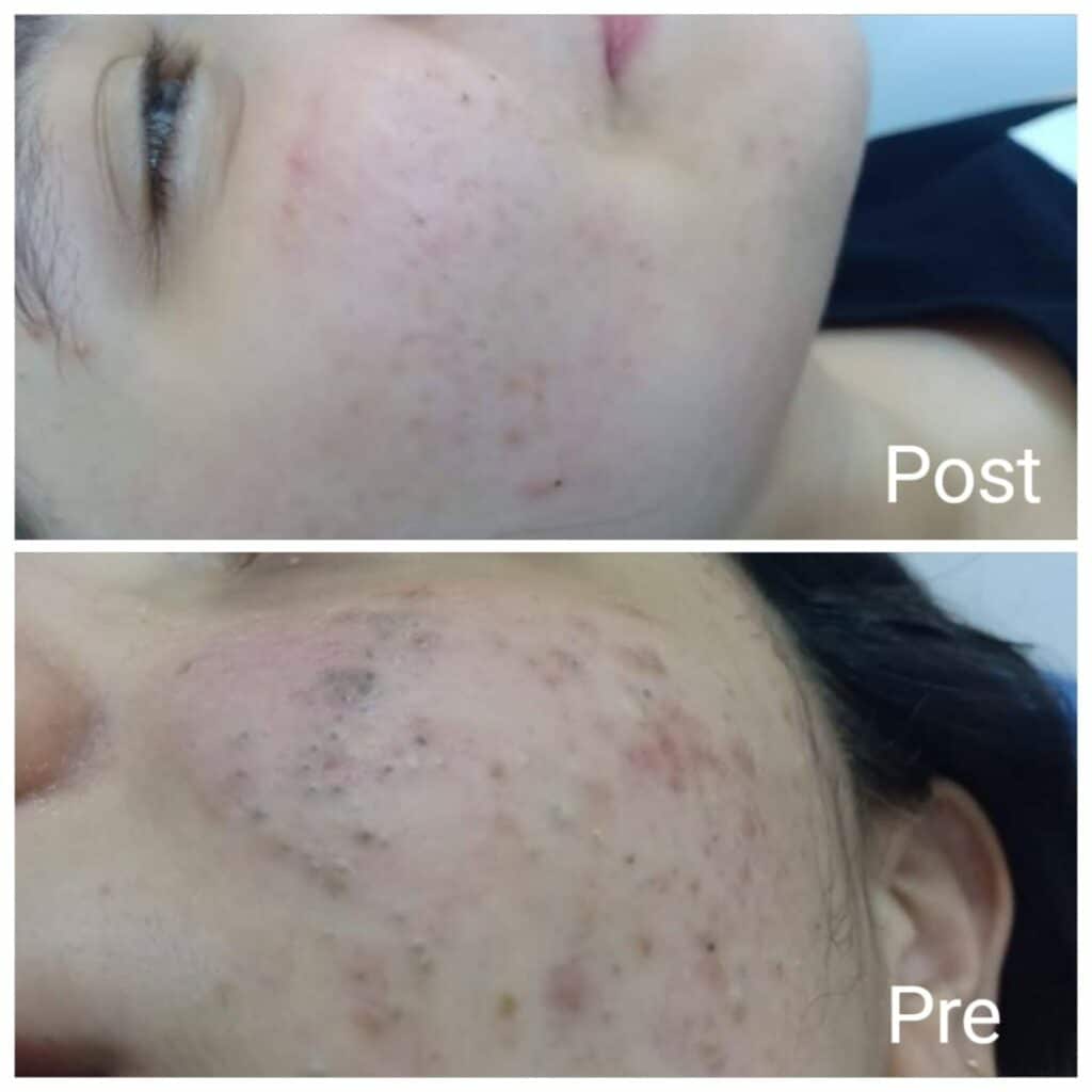 Treatment of acne scars, spots and pits on the face after 3 sessions