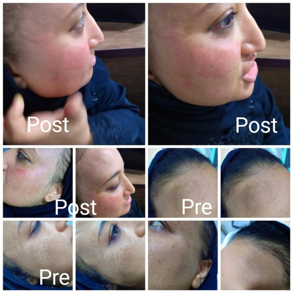 التخلص من كلف الوجه في الغردقة