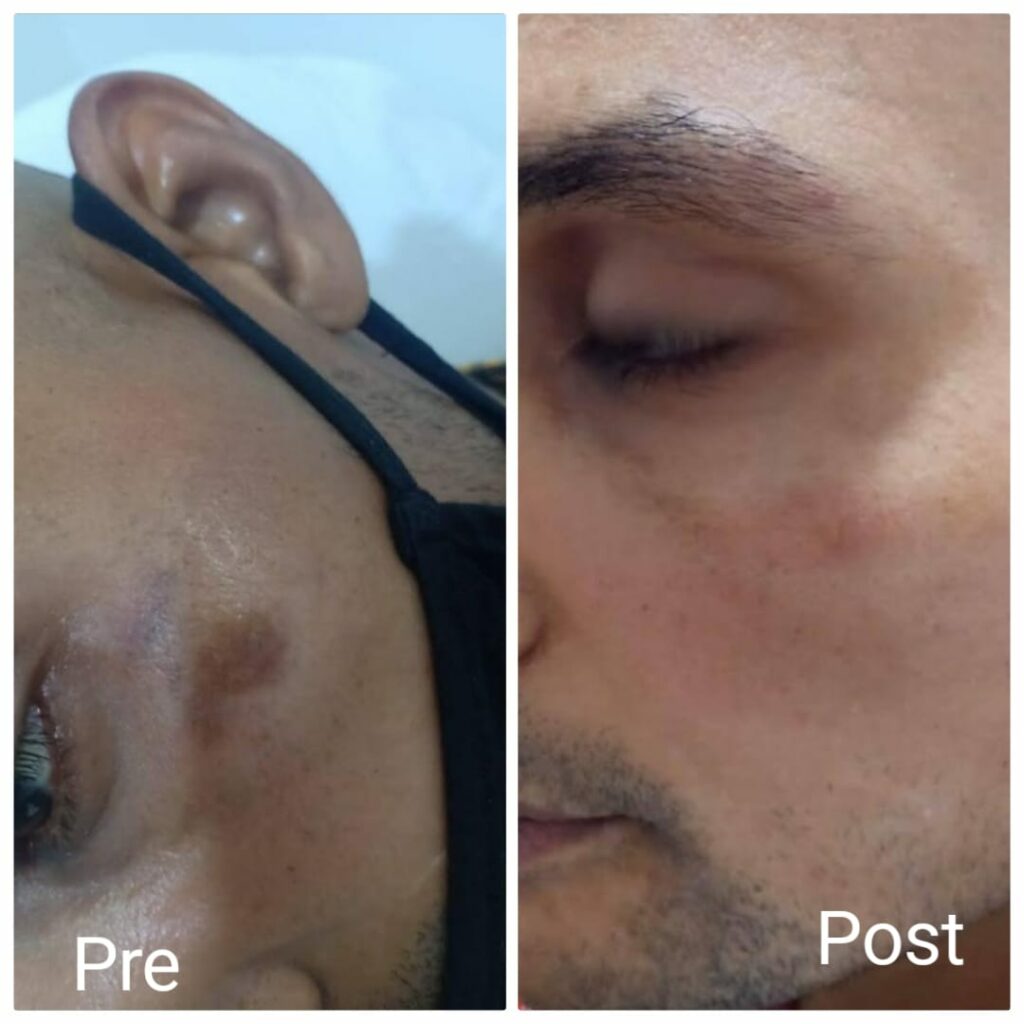 إزالة آثار الندبات وتوحيد لون البشرة