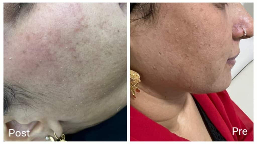 جلسات الميزوثيرابي والديرما بن في الغردقة