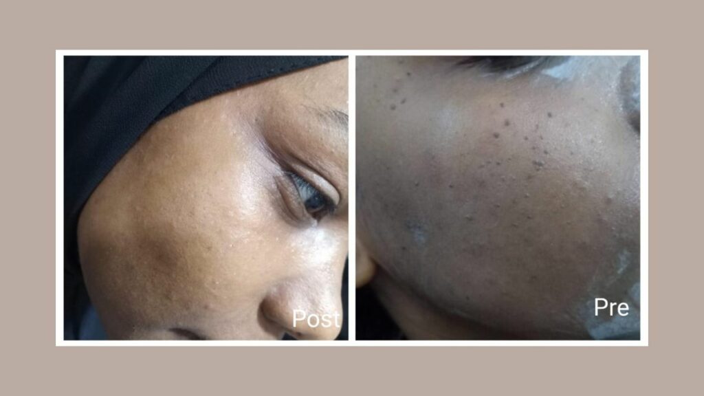 فراكشنال ليزر في الغردقة