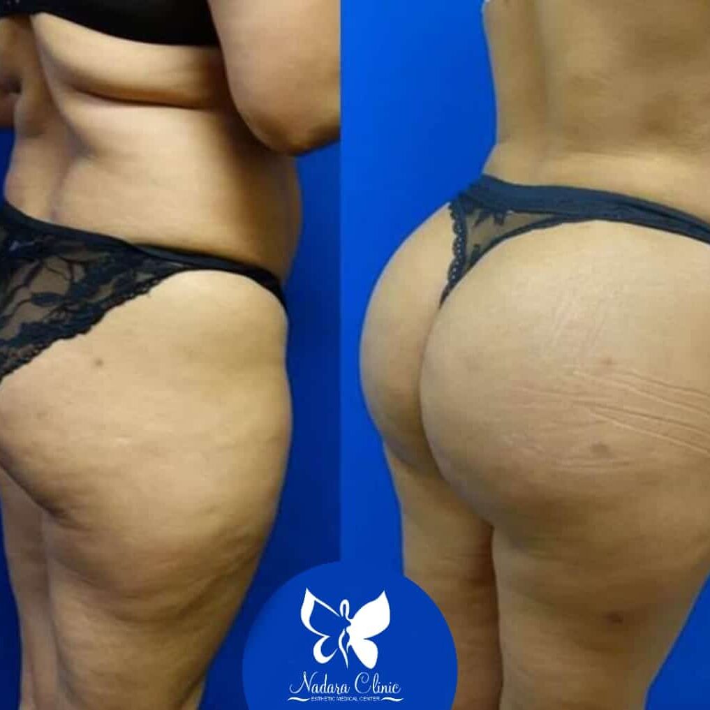 تكبير المؤخرة في الغردقة | احجز الآن | مركز نضارة للجلدية والتجميل