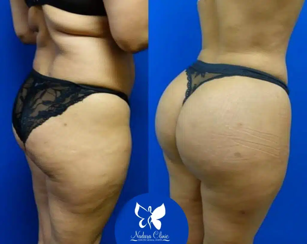 Buttock augmentation with self-fat