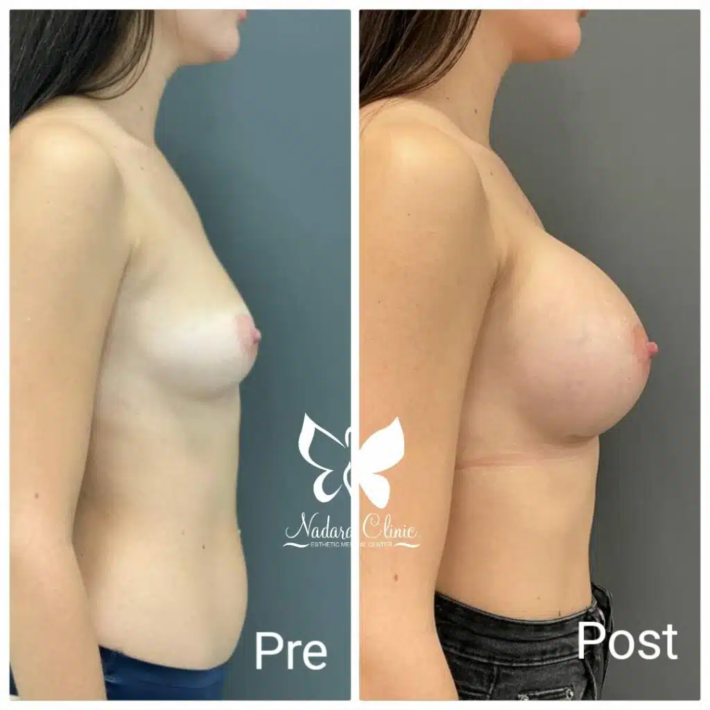 Silicon breast augmentation surgery in Hurghada