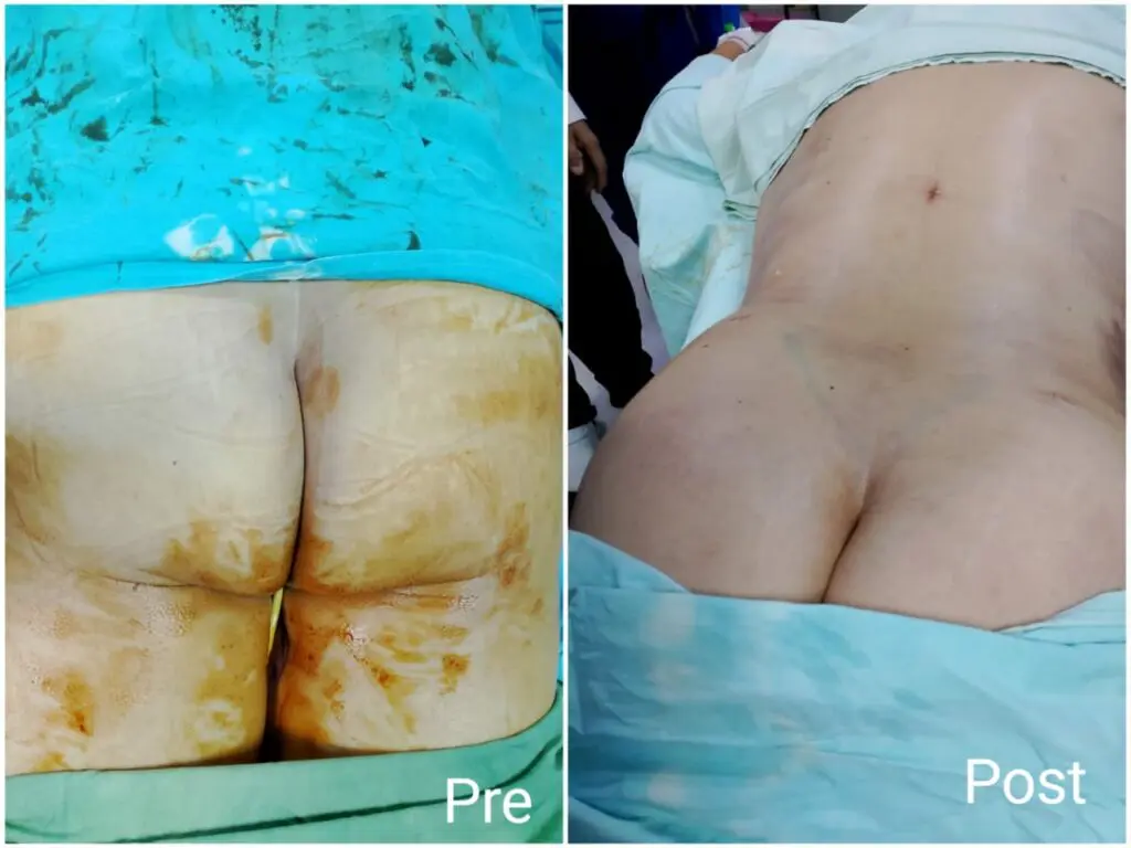 Fat injection into the buttocks before and after